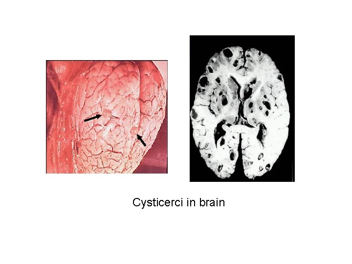 Cysticerci in brain 