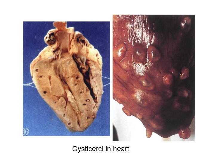 Cysticerci in heart Cysticerci in heart