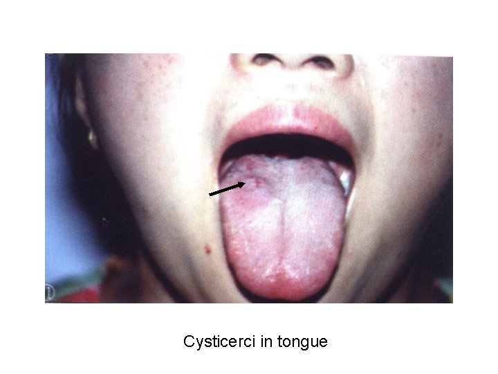 Cysticerci in tongue 