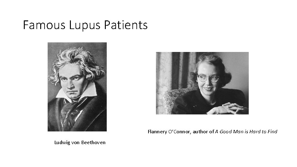 Famous Lupus Patients Flannery O’Connor, author of A Good Man is Hard to Find Famous Lupus Patients Flannery O’Connor, author of A Good Man is Hard to Find