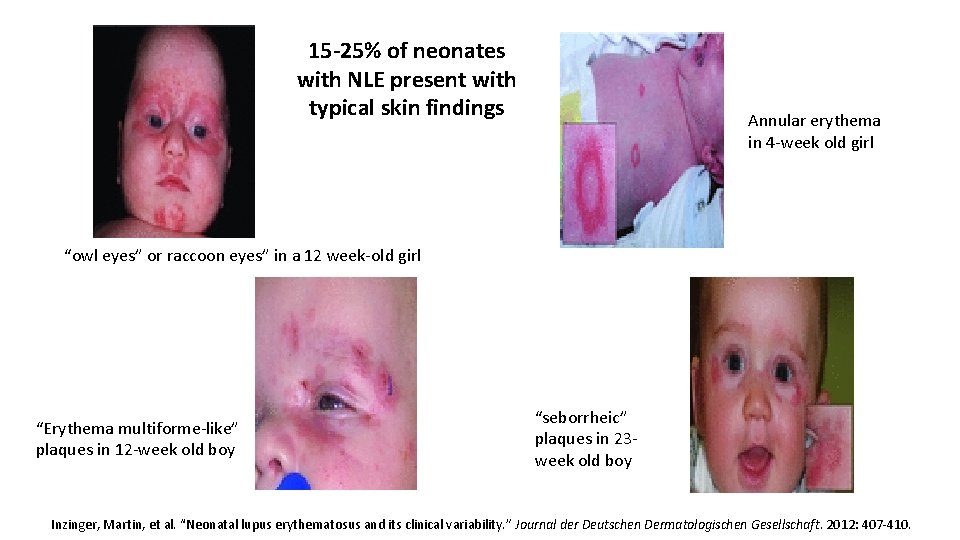 15 -25% of neonates with NLE present with typical skin findings Annular erythema in