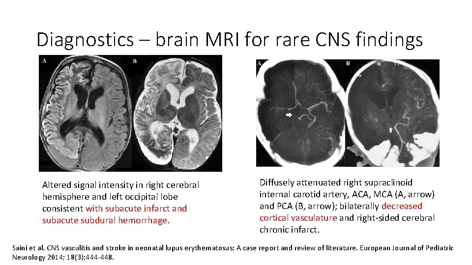 Diagnostics – brain MRI for rare CNS findings Altered signal intensity in right cerebral