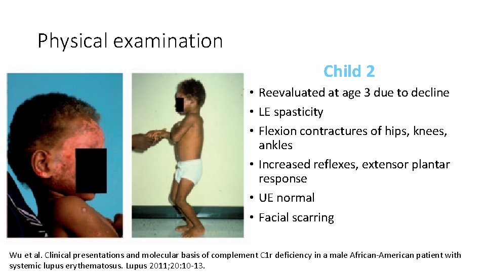 Physical examination Child 2 • Reevaluated at age 3 due to decline • LE