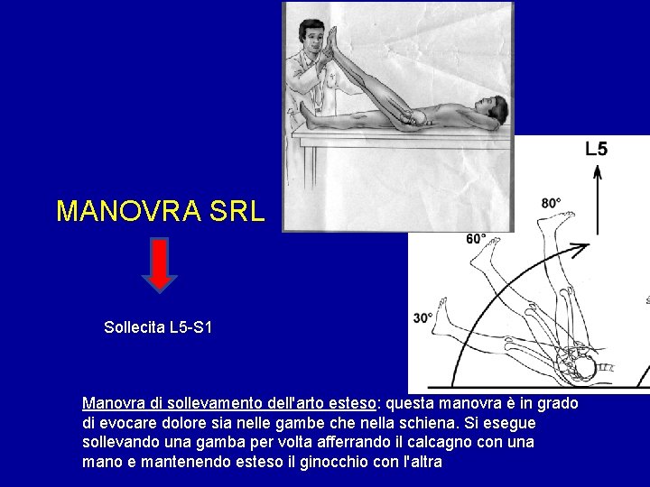 MANOVRA SRL Sollecita L 5 -S 1 Manovra di sollevamento dell'arto esteso: questa manovra