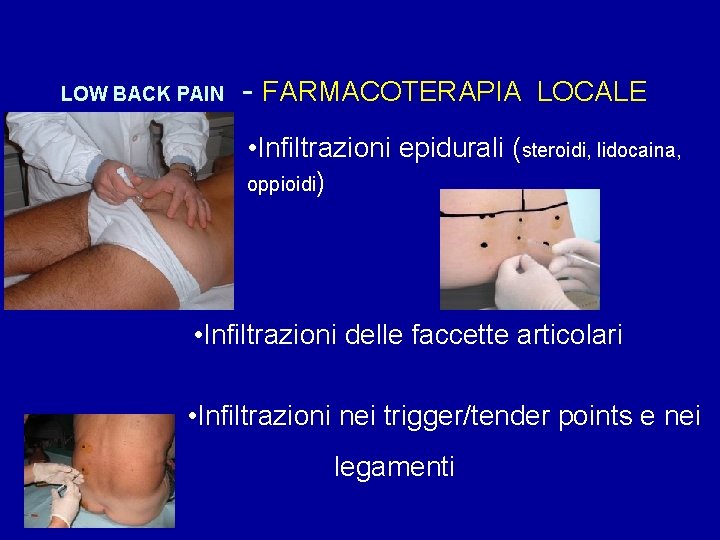 LOW BACK PAIN - FARMACOTERAPIA LOCALE • Infiltrazioni epidurali (steroidi, lidocaina, oppioidi) • Infiltrazioni