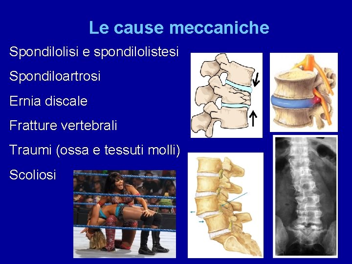 Le cause meccaniche Spondilolisi e spondilolistesi Spondiloartrosi Ernia discale Fratture vertebrali Traumi (ossa e