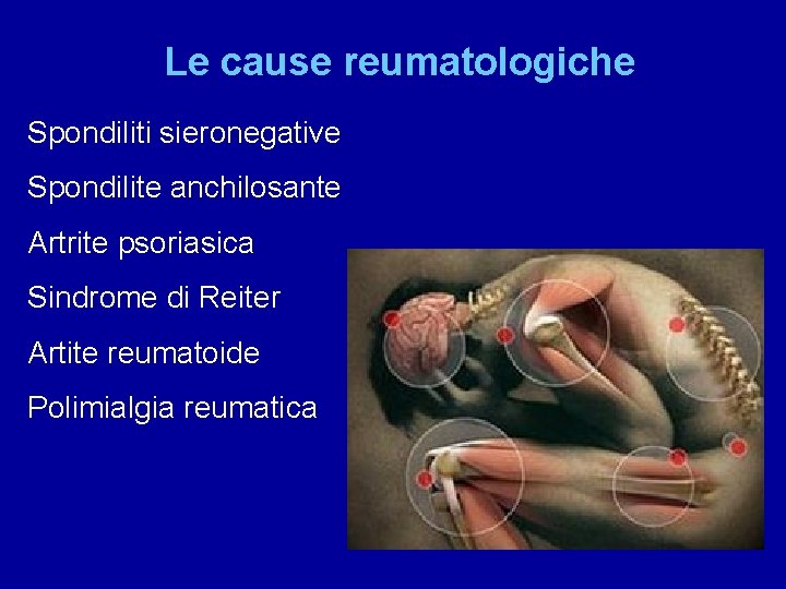 Le cause reumatologiche Spondiliti sieronegative Spondilite anchilosante Artrite psoriasica Sindrome di Reiter Artite reumatoide