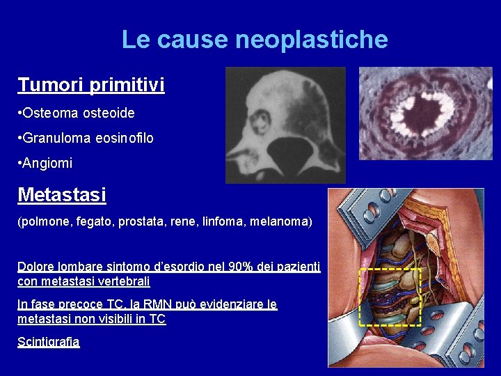 Le cause neoplastiche Tumori primitivi • Osteoma osteoide • Granuloma eosinofilo • Angiomi Metastasi