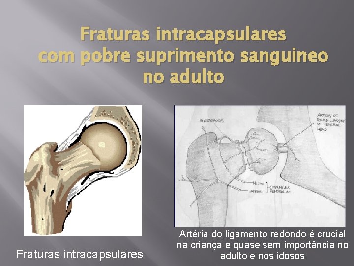 Fraturas intracapsulares com pobre suprimento sanguineo no adulto Fraturas intracapsulares Artéria do ligamento redondo