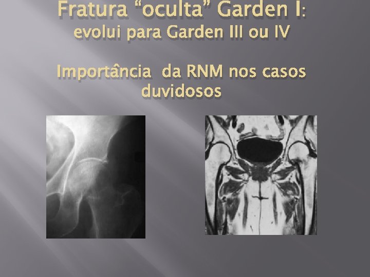 Fratura “oculta” Garden I: evolui para Garden III ou IV Importância da RNM nos