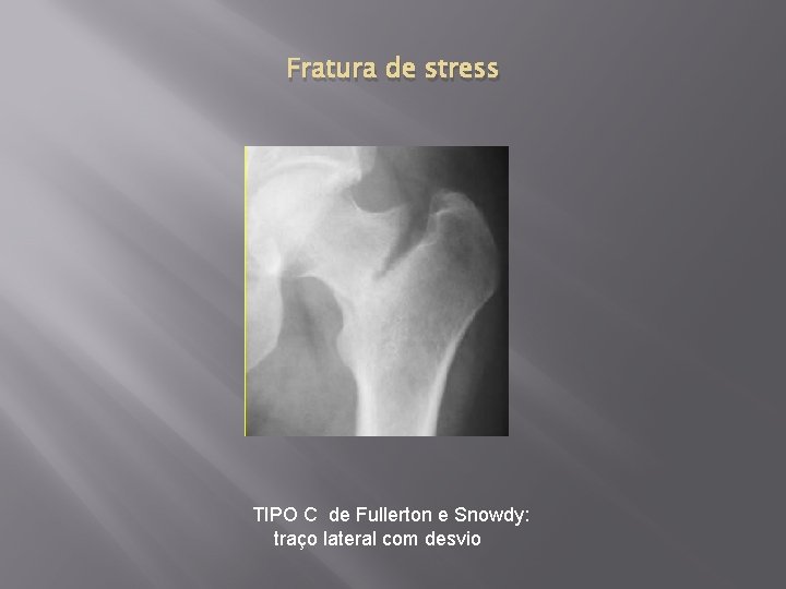 Fratura de stress TIPO C de Fullerton e Snowdy: traço lateral com desvio 