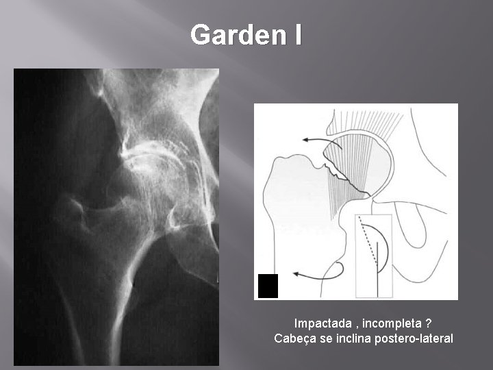 Garden I Impactada , incompleta ? Cabeça se inclina postero-lateral 