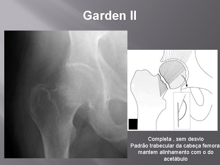 Garden II Completa , sem desvio Padrão trabecular da cabeça femoral mantem alinhamento com