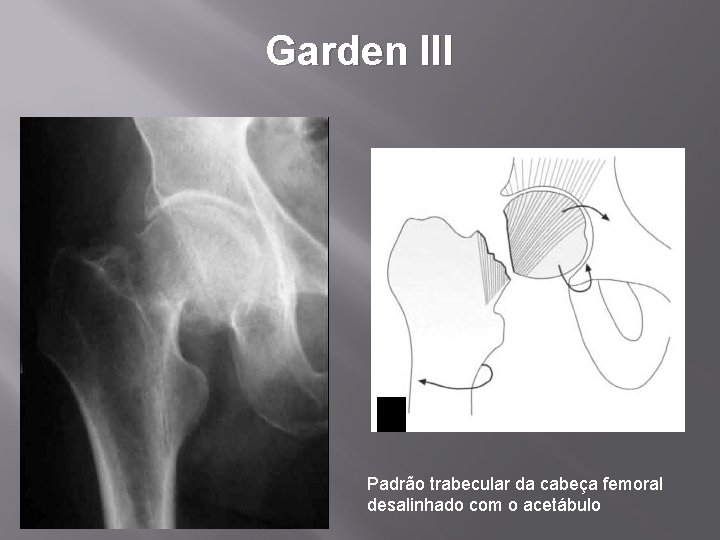 Garden III Padrão trabecular da cabeça femoral desalinhado com o acetábulo 