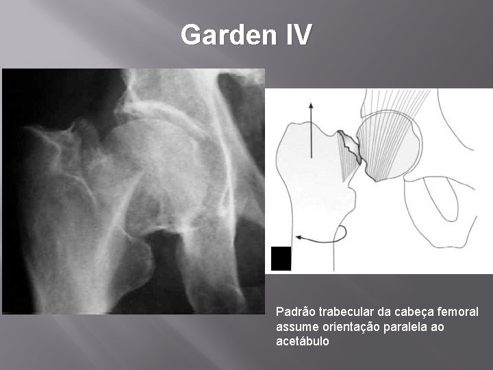 Garden IV Padrão trabecular da cabeça femoral assume orientação paralela ao acetábulo 