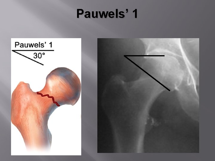 Pauwels’ 1 