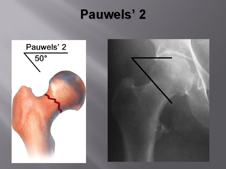 Pauwels’ 2 