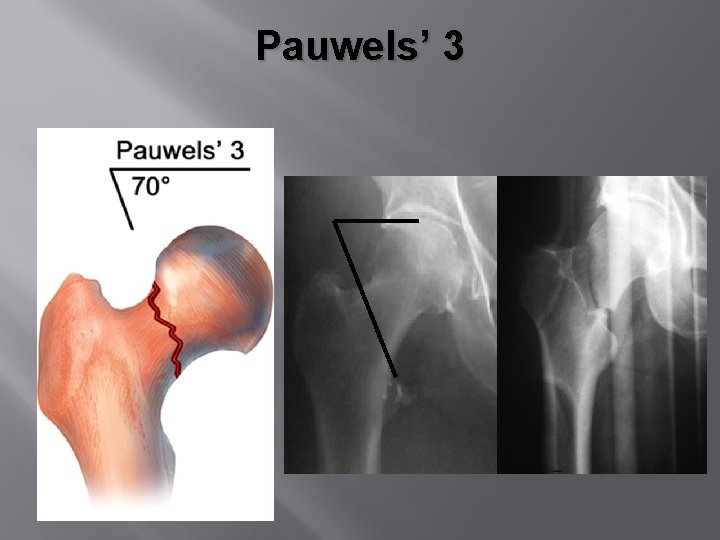 Pauwels’ 3 