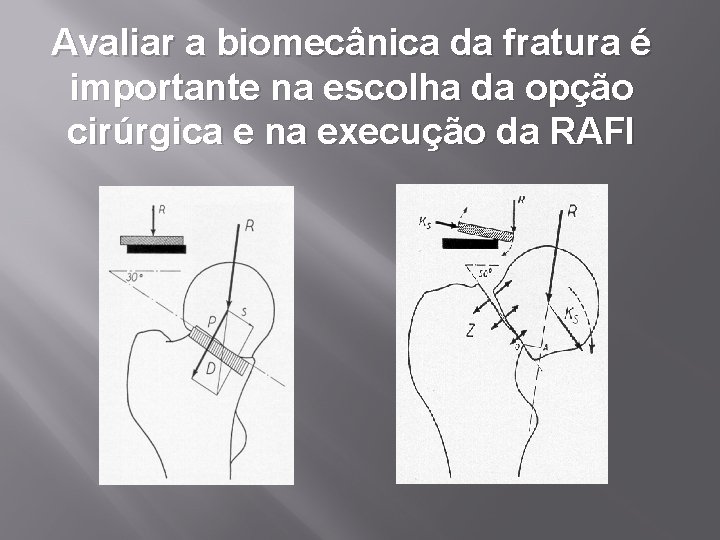 Avaliar a biomecânica da fratura é importante na escolha da opção cirúrgica e na