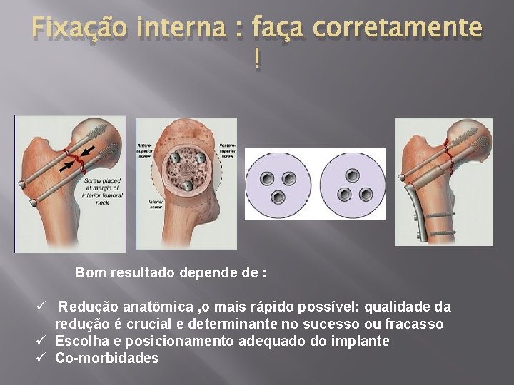 Fixação interna : faça corretamente ! Bom resultado depende de : ü Redução anatômica