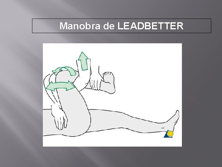 Manobra de LEADBETTER 