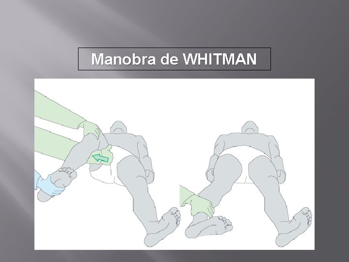 Manobra de WHITMAN 