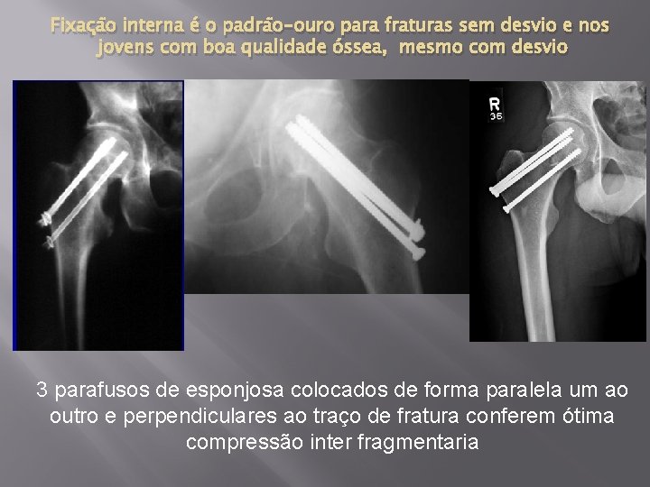 Fixação interna é o padrão-ouro para fraturas sem desvio e nos jovens com boa