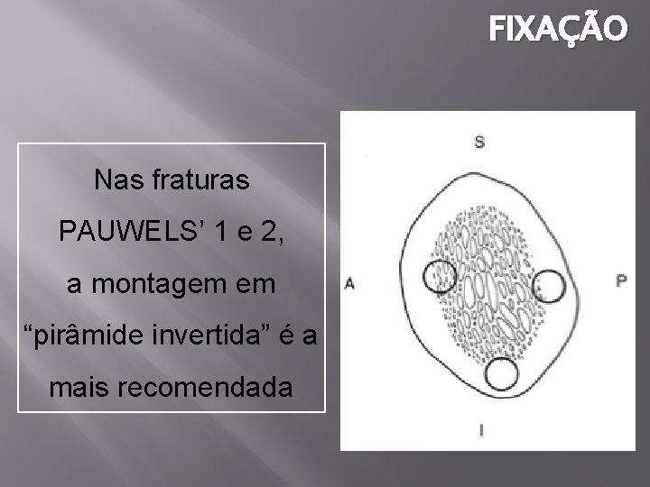 FIXAÇÃO Nas fraturas PAUWELS’ 1 e 2, a montagem em “pirâmide invertida” é a