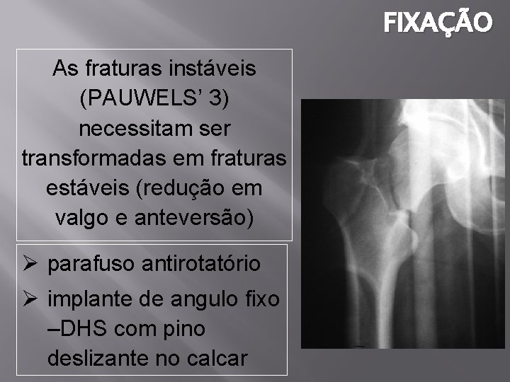 FIXAÇÃO As fraturas instáveis (PAUWELS’ 3) necessitam ser transformadas em fraturas estáveis (redução em