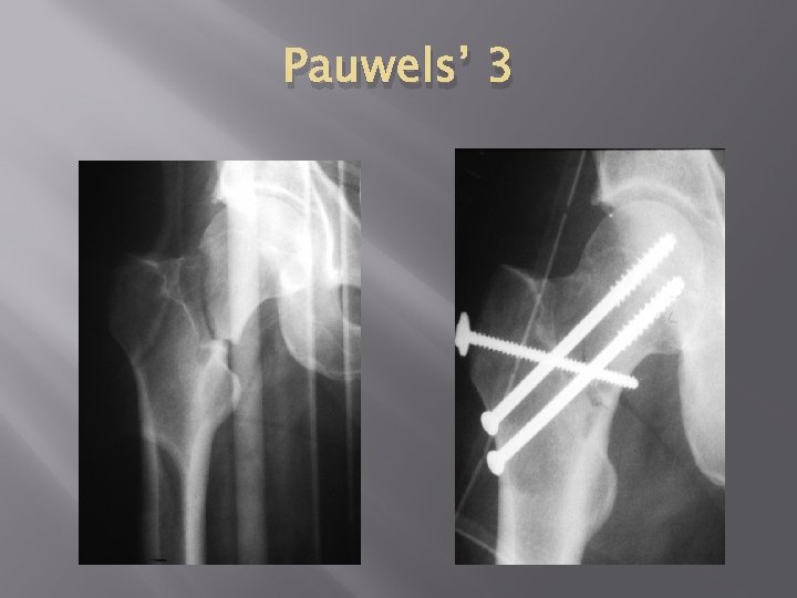 Pauwels’ 3 