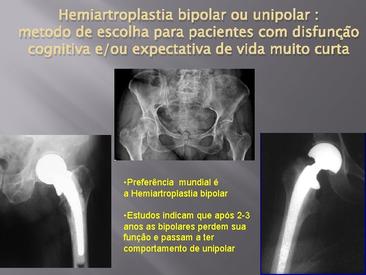 Hemiartroplastia bipolar ou unipolar : metodo de escolha para pacientes com disfunção cognitiva e/ou