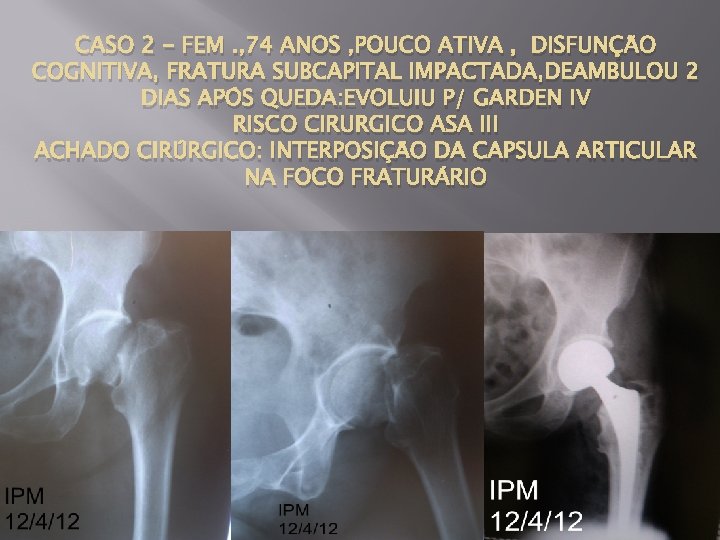 CASO 2 - FEM. , 74 ANOS , POUCO ATIVA , DISFUNÇÃO COGNITIVA, FRATURA