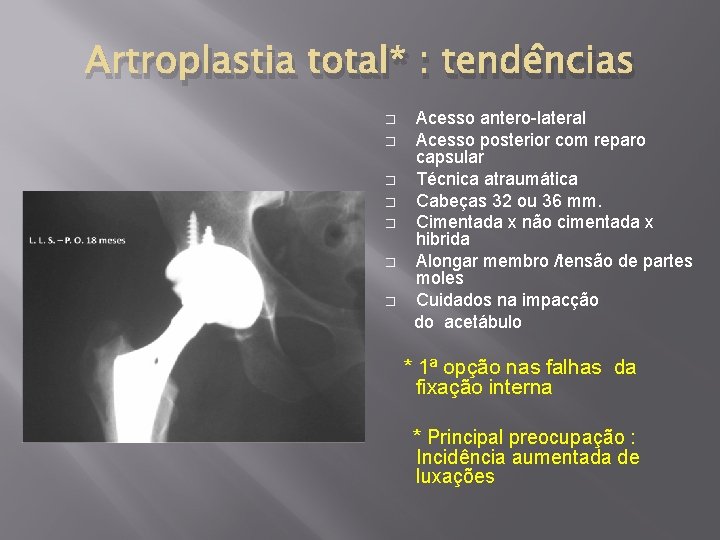 Artroplastia total* : tendências Acesso antero-lateral � Acesso posterior com reparo capsular � Técnica