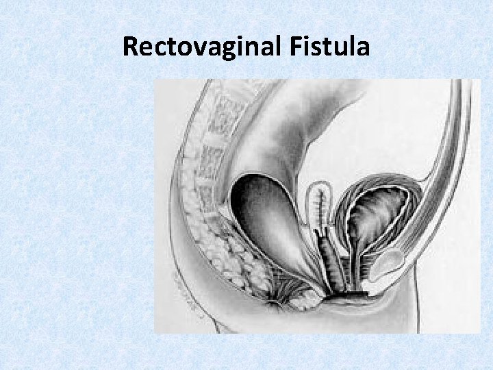 Rectovaginal Fistula 