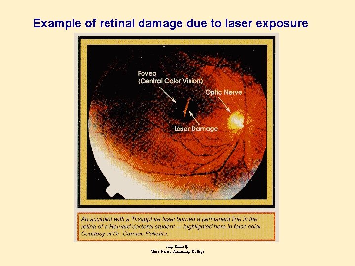 Example of retinal damage due to laser exposure Judy Donnelly Three Rivers Community College