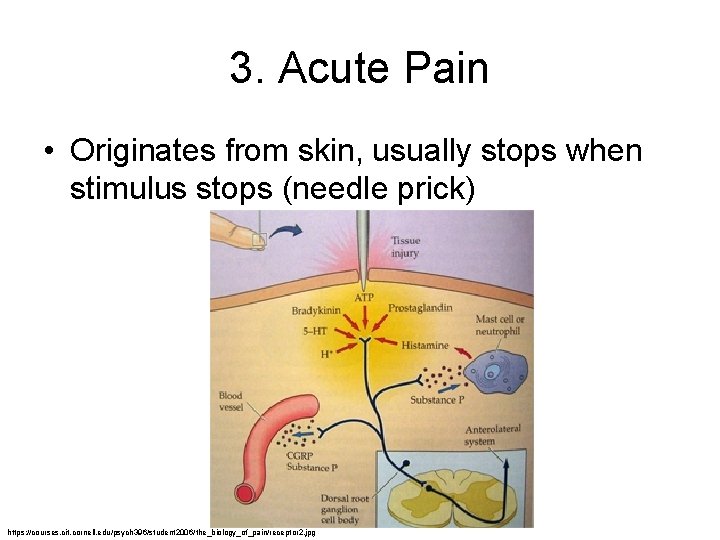 3. Acute Pain • Originates from skin, usually stops when stimulus stops (needle prick)