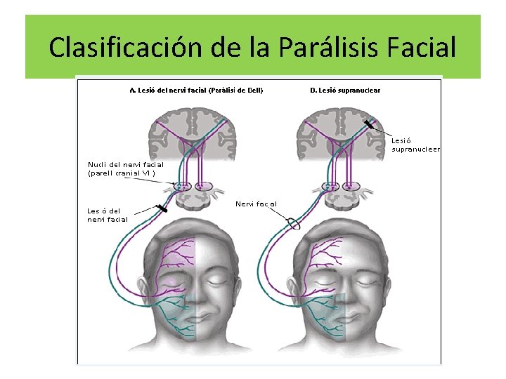 Clasificación de la Parálisis Facial 