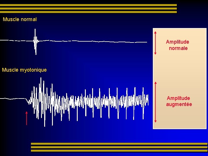 Muscle normal Amplitude normale Muscle myotonique Amplitude augmentée 