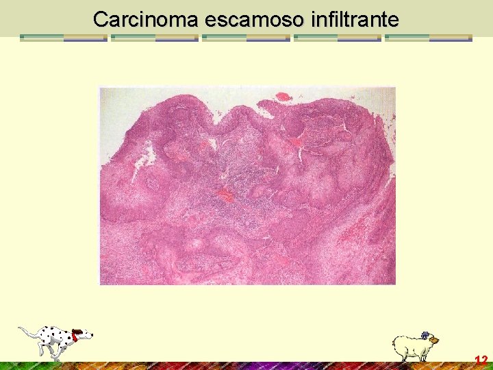 Carcinoma escamoso infiltrante 12 