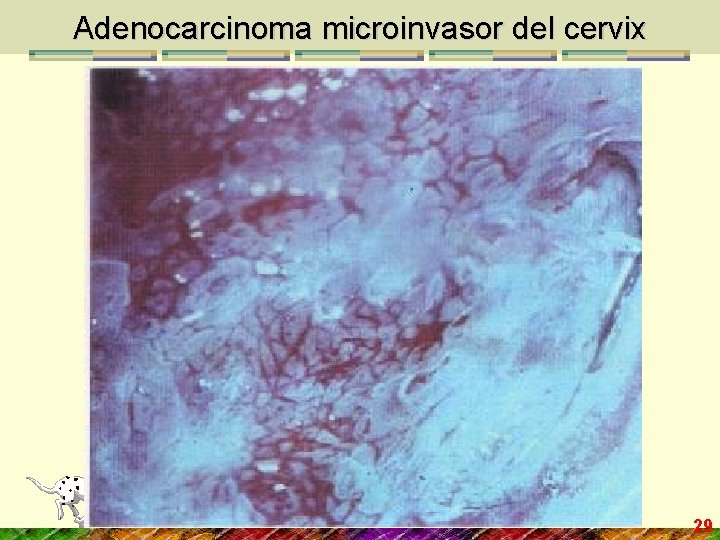 Adenocarcinoma microinvasor del cervix 29 