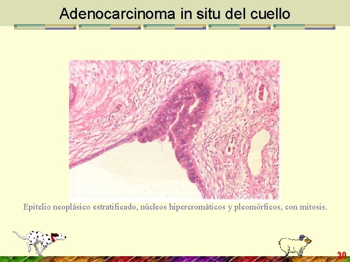 Adenocarcinoma in situ del cuello Epitelio neoplásico estratificado, núcleos hipercromáticos y pleomórficos, con mitosis.