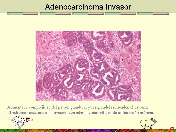 Adenocarcinoma invasor Aumenta la complejidad del patrón glandular y las glándulas invaden el estroma.