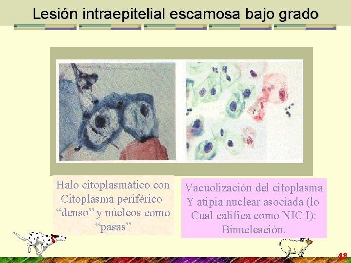 Lesión intraepitelial escamosa bajo grado Halo citoplasmático con Citoplasma periférico “denso” y núcleos como