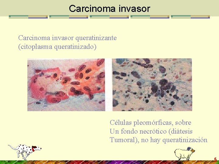 Carcinoma invasor queratinizante (citoplasma queratinizado) Células pleomórficas, sobre Un fondo necrótico (diátesis Tumoral), no