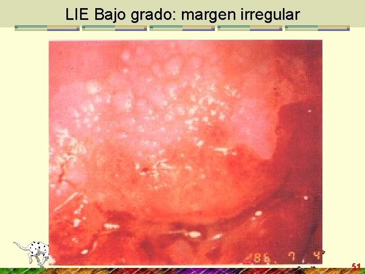 LIE Bajo grado: margen irregular 51 