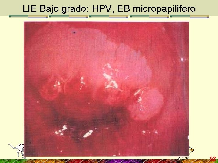 LIE Bajo grado: HPV, EB micropapilifero 52 