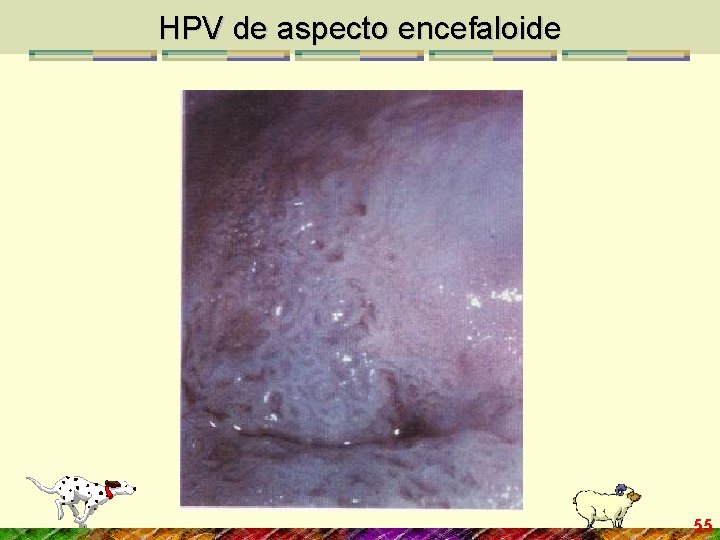 HPV de aspecto encefaloide 55 