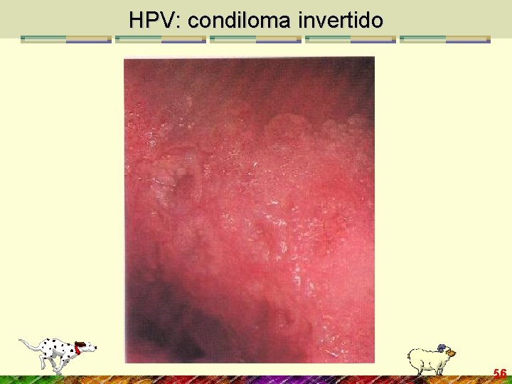 HPV: condiloma invertido 56 