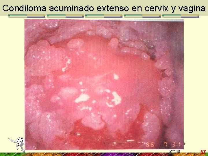 Condiloma acuminado extenso en cervix y vagina 57 