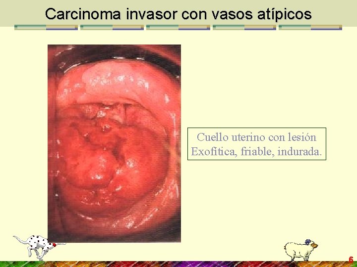 Carcinoma invasor con vasos atípicos Cuello uterino con lesión Exofítica, friable, indurada. 6 